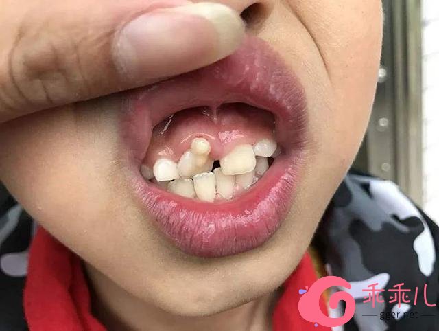 如果 孩子的乳牙根尖发生不良病变,让牙龈和牙根不能及时地分开,乳牙